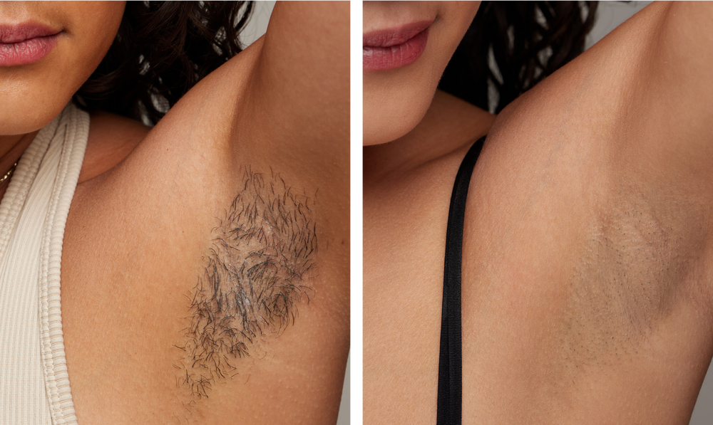 Ulike Air 2 Max underarm treatment image